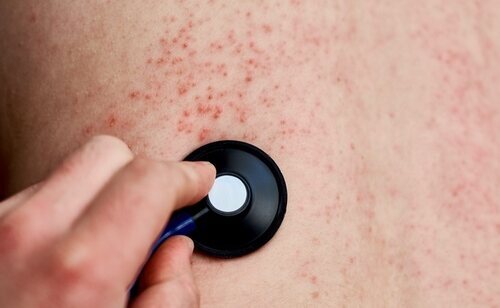 La OMS advierte sobre la progresiva expansión del sarampión